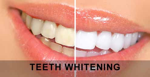 blegning af tænder hos tandlægen